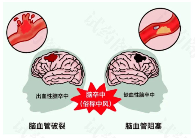 脑卒中发病原理