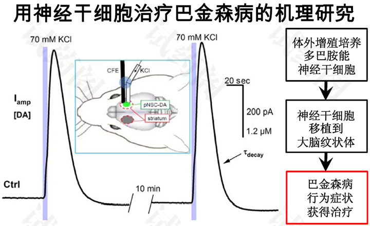 全球帕金森病干细胞治疗临床试验综述